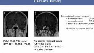 Acromegaly Medical Management Considerations [upl. by Emiaj]