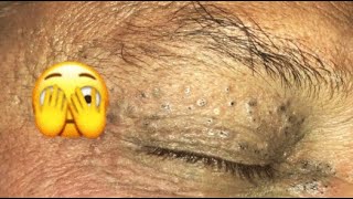 UNBELIEVABLE  LOOK AT THIS EYE HOW FULL OF BLACKHEAD😨 Part1 relaxing blackheads [upl. by Assiroc]