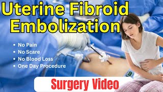 Uterine Fibroid Embolization  Surgery Video [upl. by Ilowell441]