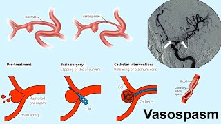 vasospasm [upl. by Calla]