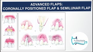 ADVANCED PEDICLE FLAPS CORONALLY POSITIONED FLAP SEMILUNAR FLAP ROOT COVERAGE DR ANKITA [upl. by Jon]