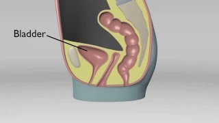 Cystocele No Uterus [upl. by Arimay]