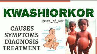 KWASHIORKOR  CAUSES  SYMPTOMS  DIAGNOSIS  TREATMENT [upl. by Rodolfo]