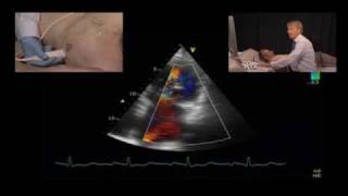 Jet Direction and the Mechanism of Mitral Regurgitation [upl. by Sikes]