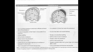 Cephalohematoma and Caput succedaneum  Short lacture [upl. by Tyree]