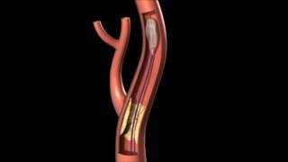 CarotisAngioplastie mit Stent und Protektionssystem [upl. by Yna]