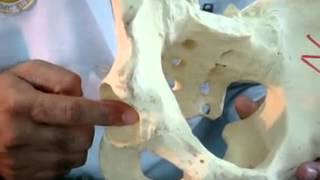 Salter’s innominate Osteotomy in Developemental Dysplastic Hip on Saw Bone Model [upl. by Ennovad]