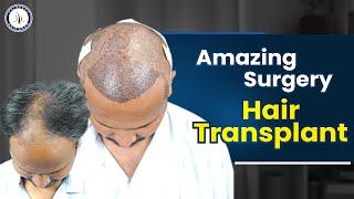 Hair Transplant in Hyderabad  Cost of Hair Transplant And Hair Transplant Doctor in Hyderabad [upl. by Ehrsam]