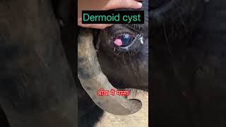 Dermoid cyst l dr Umar khan [upl. by Babby]