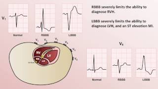 Intro to EKG Interpretation  Bundle Branch Blocks [upl. by Kono516]