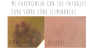 Mi experiencia con los tatuajes  Cómo eliminarlos [upl. by Ruenhcs]