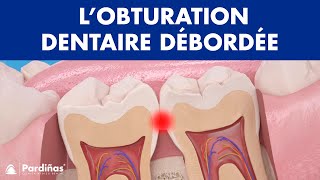 Couronne sur implant dentaire [upl. by Ellevart]