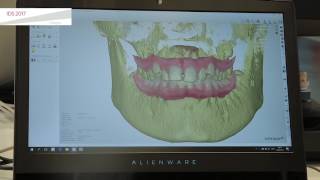 IDS2017 3Shape Ortho Analyzer  Diagnostics Analysis and Treatment Planning [upl. by Ahsym572]