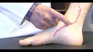 How to diagnose Posterior Tibial Tendonitis [upl. by Hubey637]