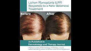 Published Report Lichen Planopilaris LPP Responds to the Natural Hair Treatment Formula  Gashee [upl. by Glovsky348]