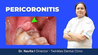 What is Pericoronitis  How does it occur How is it treated I Home remedies for Pericoronitis I [upl. by Jairia]