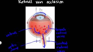 Retinal vein occlusion [upl. by Nat]