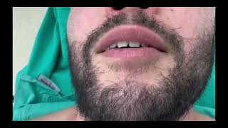 Voice DeepeningMasculinization Surgery [upl. by Eeniffar]