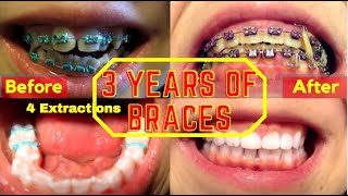 Braces in 1 Minute  Time Lapse  4 Teeth EXTRACTIONS amp SEVERE Overbite [upl. by Habas]