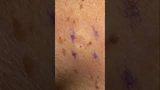 Age Spot Removal  Completely Gone [upl. by Teddy]