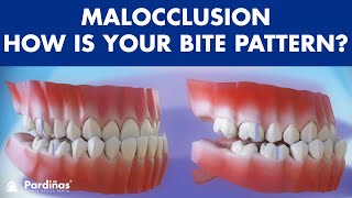 Malocclusion  Bite patterns © [upl. by Safir753]