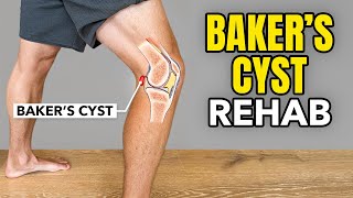 Bakers Cyst Treatment Rehab Exercises [upl. by Hollington154]