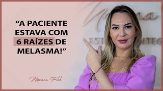 Esse é o principal motivo pelo qual eu não falo qual a RAIZ DO MELASMA entenda como funciona [upl. by Niwred835]