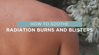 How to Soothe Radiation Burns and Blisters [upl. by Donahue]