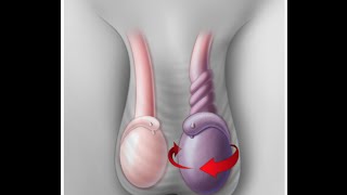 Testicular Torsion [upl. by Lorelie]