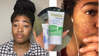 HOW TO USE ADAPALENE GEL 01 FOR ACNEMY MORNING SKINCARE ROUTINE FOR ACNE shorts adapalenegel [upl. by Adel915]