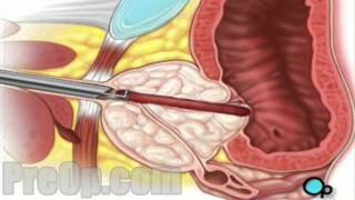 TURP Transurethral Resection Prostate Penis and Bladder  PreOp® Surgery  Patient Education [upl. by Alym310]