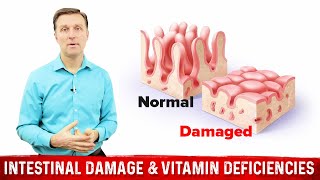 Intestinal Obstruction amp Vitamin Deficiencies – Dr Berg [upl. by Torrey]