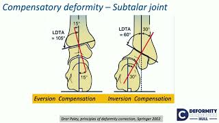 Compensatory theory of osteotomies around kneeEffect on Hip amp FampA alternate ways  H Sharma [upl. by Lally741]