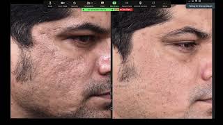 Combination Treatment of Acne Scars [upl. by Adnirod]