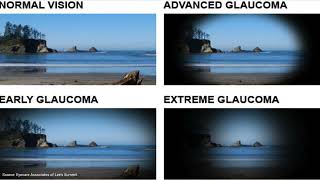 Glaucoma  An Introduction for Patients [upl. by Trilby]