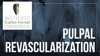 Pulpal revascularization [upl. by Beitz]