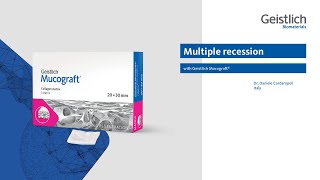 Multiple recession with Geistlich Mucograft® [upl. by Wearing119]