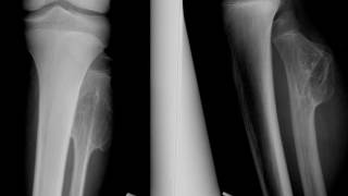 Osteochondroma of the fibula [upl. by Adnoryt]