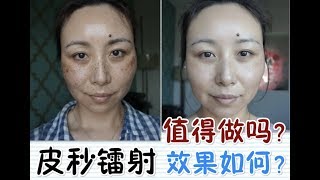 PicoSure Laser Review  BeforeampAfter皮秒镭射体验＋前后对比MsLindaY [upl. by Neslund826]