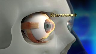 Keratoconus Procedure Explained [upl. by Audette]