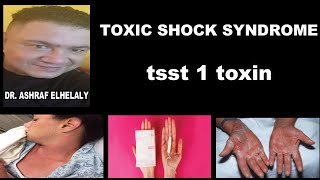 3 Bacteriology  staphylococcal toxic shock syndrome  pathology clinical presentation diagnosis [upl. by Wagshul423]