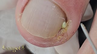 PUS viral satisfying [upl. by Ker]