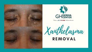 Xanthelasma Removal [upl. by Elayor920]