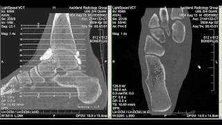 CT Arthrogram of my Ankle 2 April 2009 [upl. by Ellenehc777]