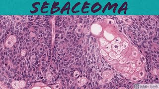 Sebaceoma 5Minute Pathology Pearls [upl. by Hnid955]