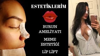 HER YERİM ESTETİK   Burun Estetiği Göğüs Estetiği  Kaç Estetiğim Var [upl. by Sesmar945]