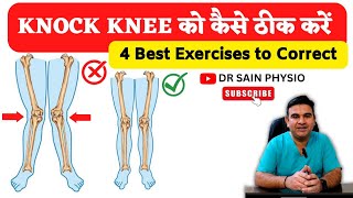 Knock Knee को कैसे ठीक करें  4 Best Exercises to Correct  Knock Knee problem solution knockknee [upl. by Tiras301]