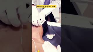 External Jugular Vein  Cannula insertion  Cannulation  EJV cannula ineet cannula cannulation [upl. by Latsyrk221]