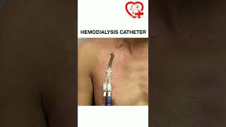 Hemodialysis catheter shorts shortspeed anatomy [upl. by Warenne23]