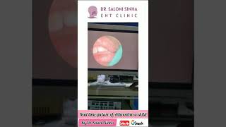 Watch What This Doctor Uncovers During Endoscopic Examination of a Childs Adenoid Hypertrophy [upl. by Aehcim]